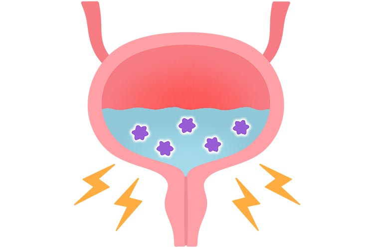 膀胱炎イメージ